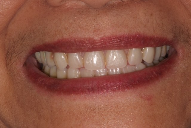 After treatment
